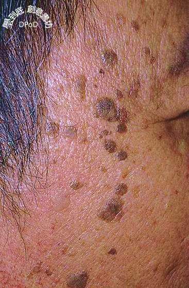 角化   seborrheic keratosis 说明 这是老年人最常见的病,俗称老人斑