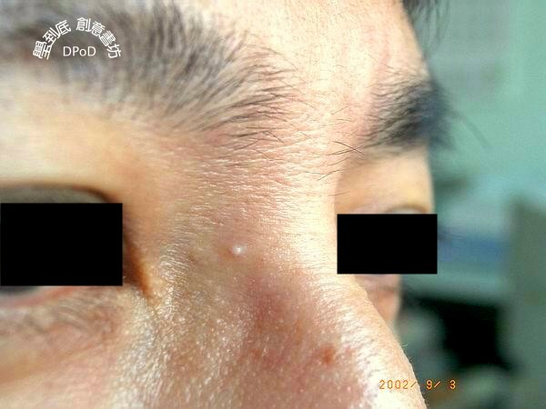 46岁男性主诉鼻梁部有颗小小硬硬白色丘疹已有许多年,不痛不痒,不会